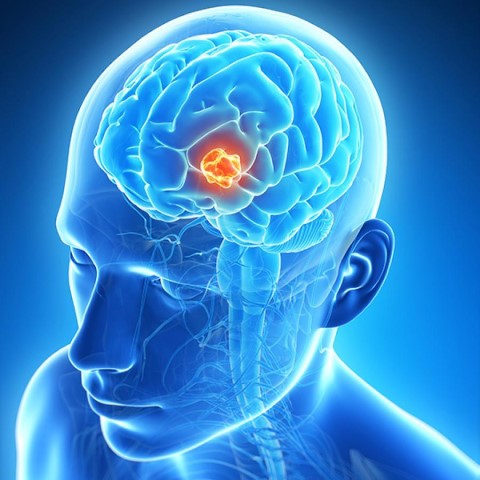 probleme de vedere cu cancer la creier